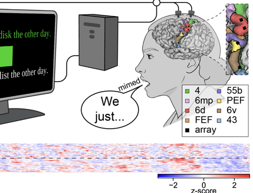 Restoring brain-to-text communication in a person with dysarthria from pontine stroke using an intracortical brain-computer interface